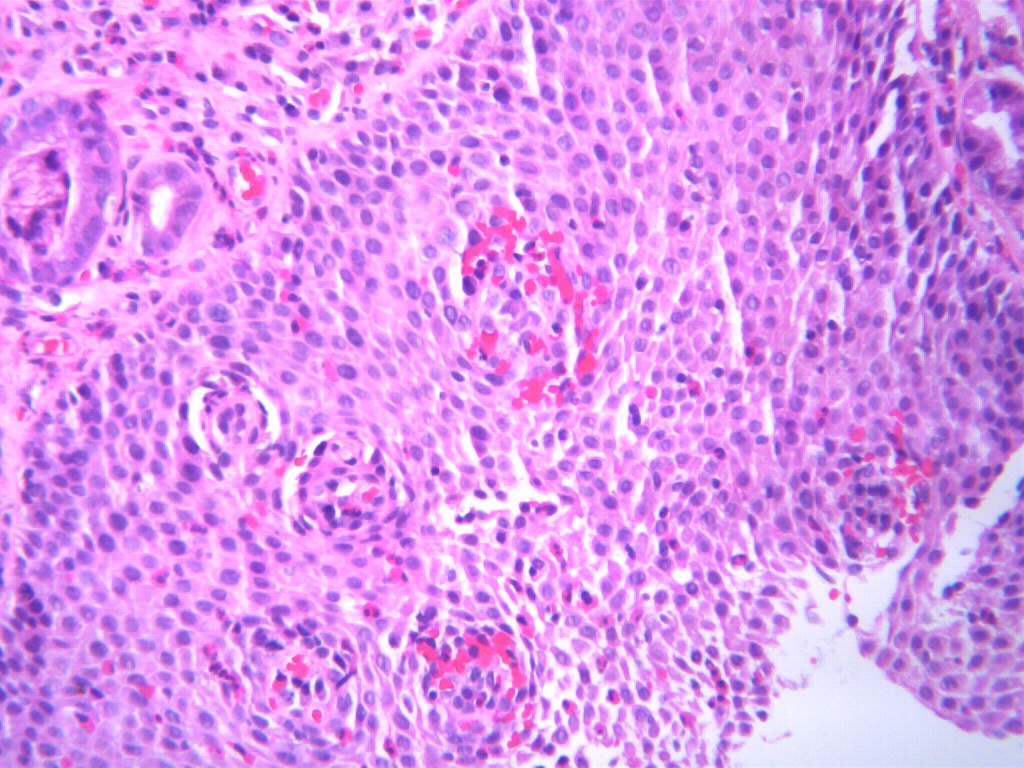 Eosinophile Ösophagitis
Eosinophile Mikrosabszesse und Vermehrung von eosinophilen Granuloyzten